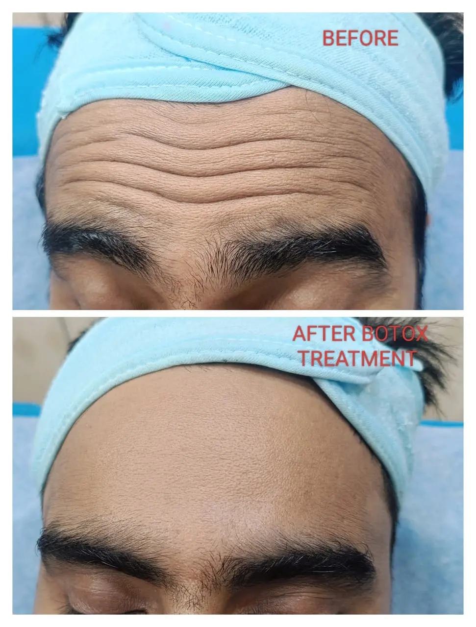 Best Anti Wrinkles treatment in Skin Care Clinic near me Lucknow