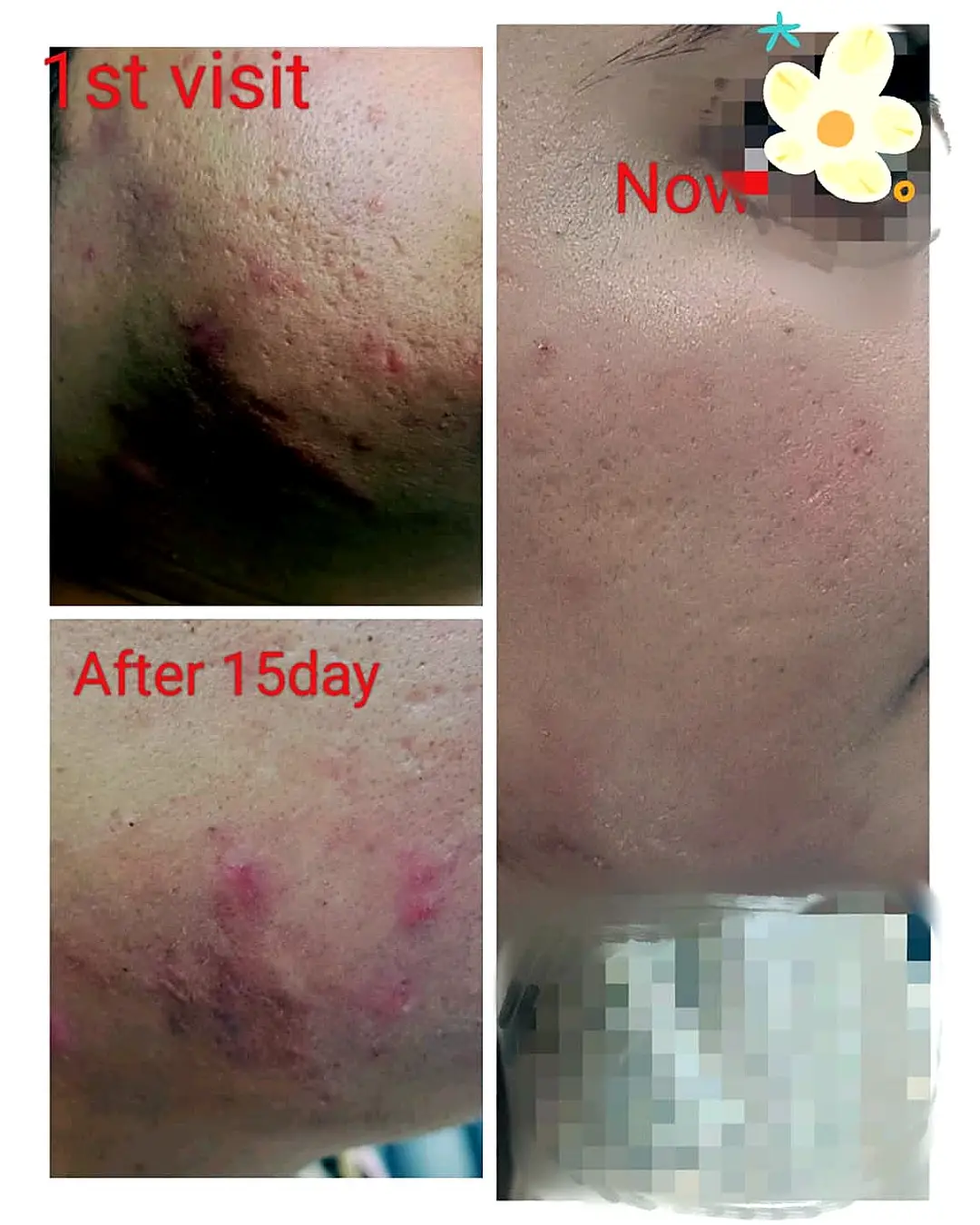 Best Acne Clinic in Lucknow
