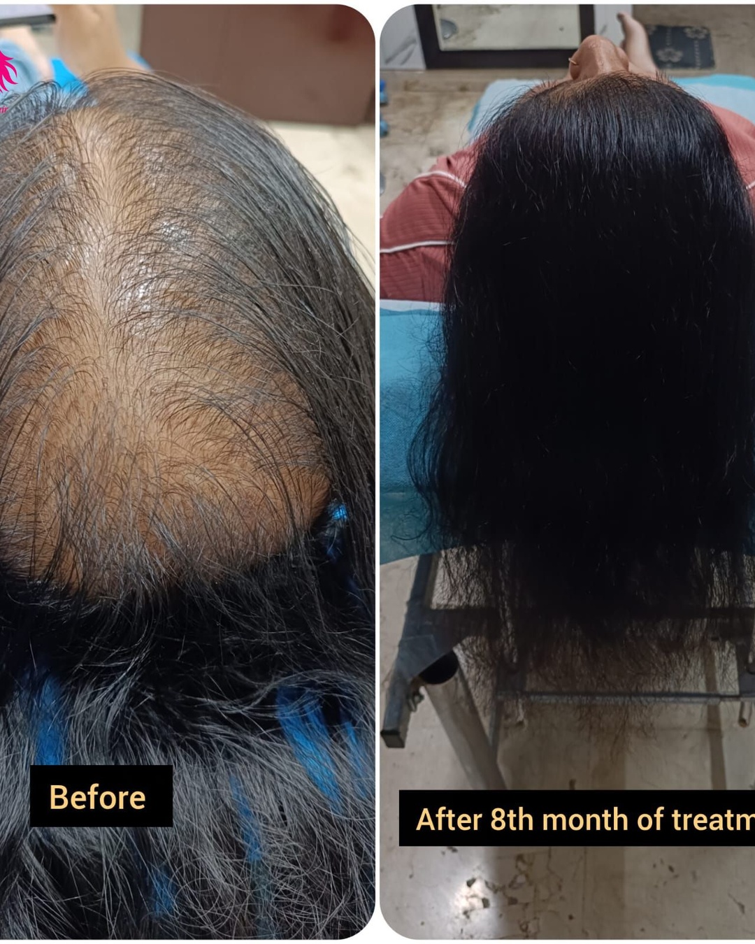 Hair transplant treatment near me