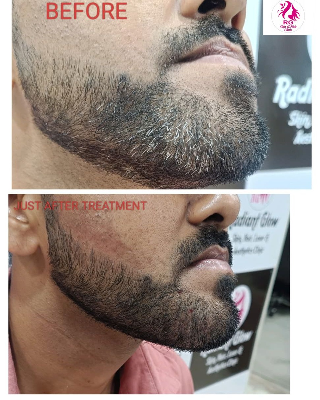 Best Electrolysis treatment in Lucknow