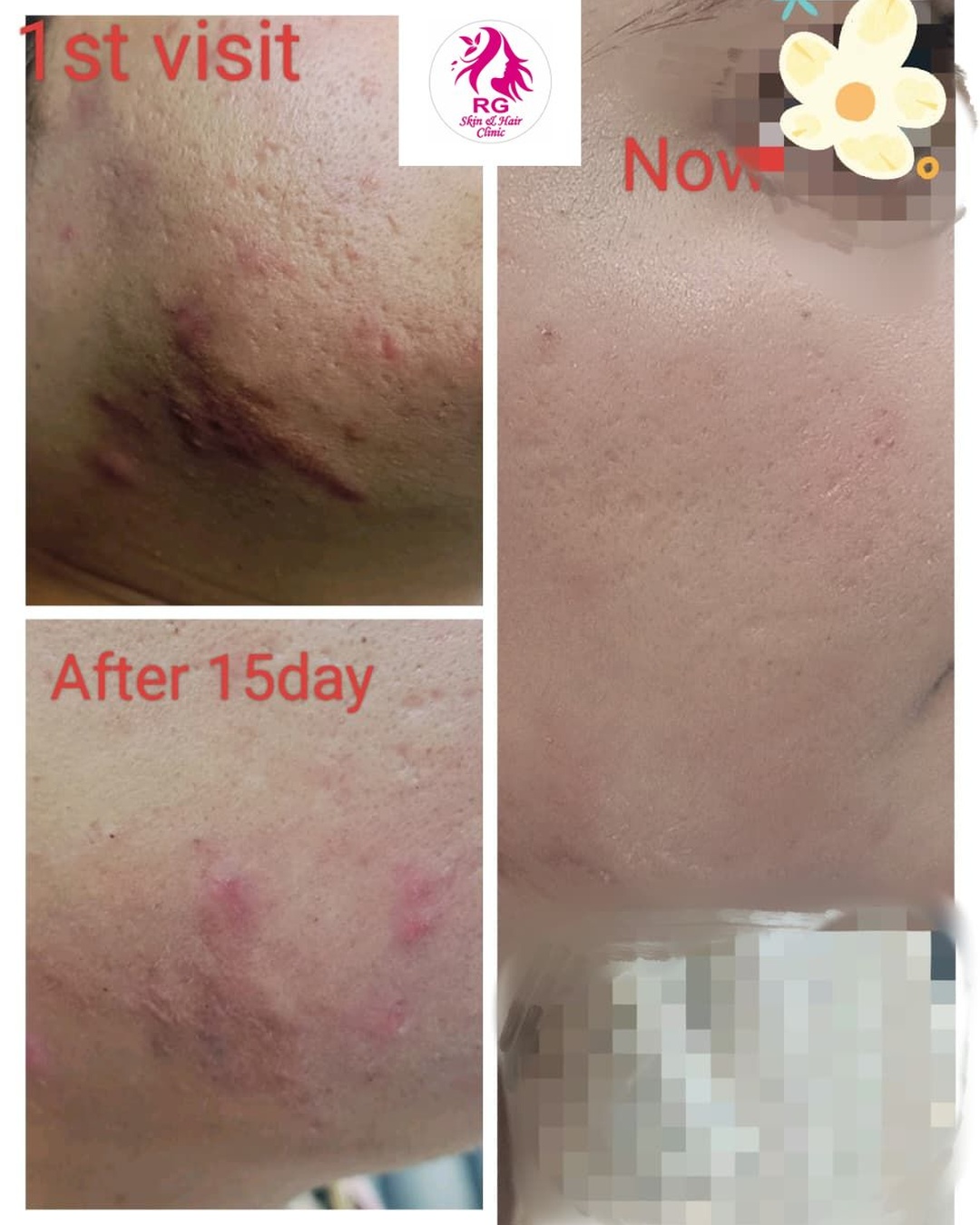Best Pimples treatment near me