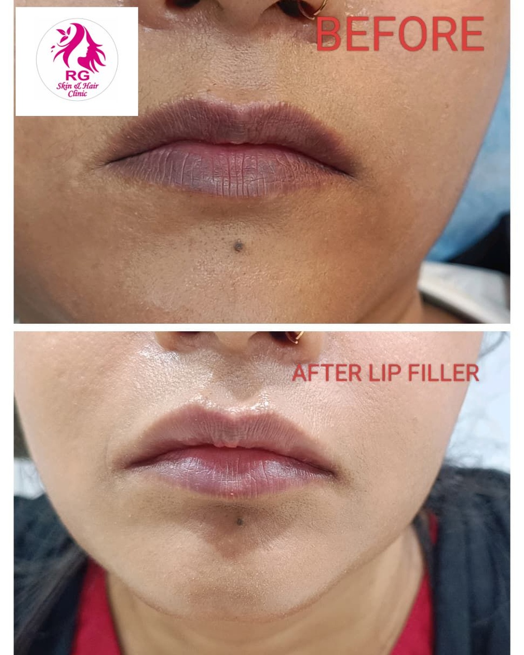 Best lip filler treatment near me