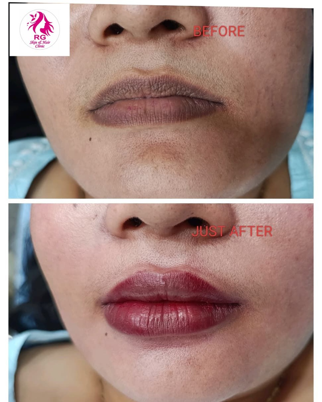 best Lip filler treatment near me