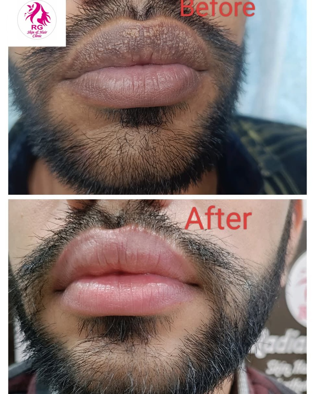 Best lip filler treatment near me