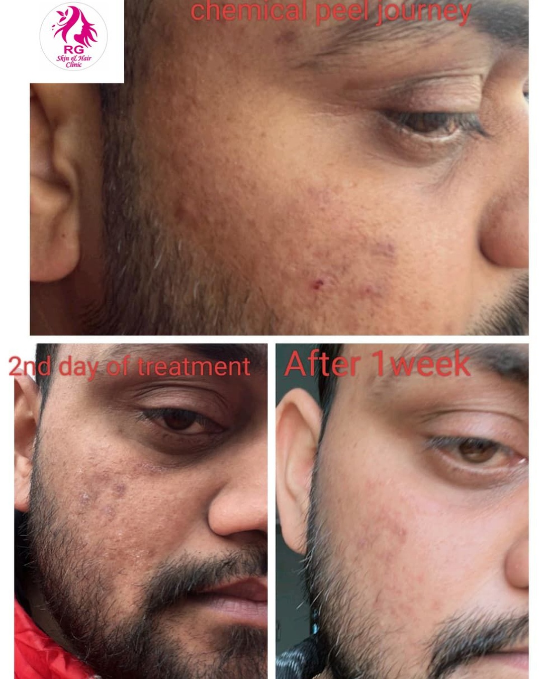 Best acne treatment near me