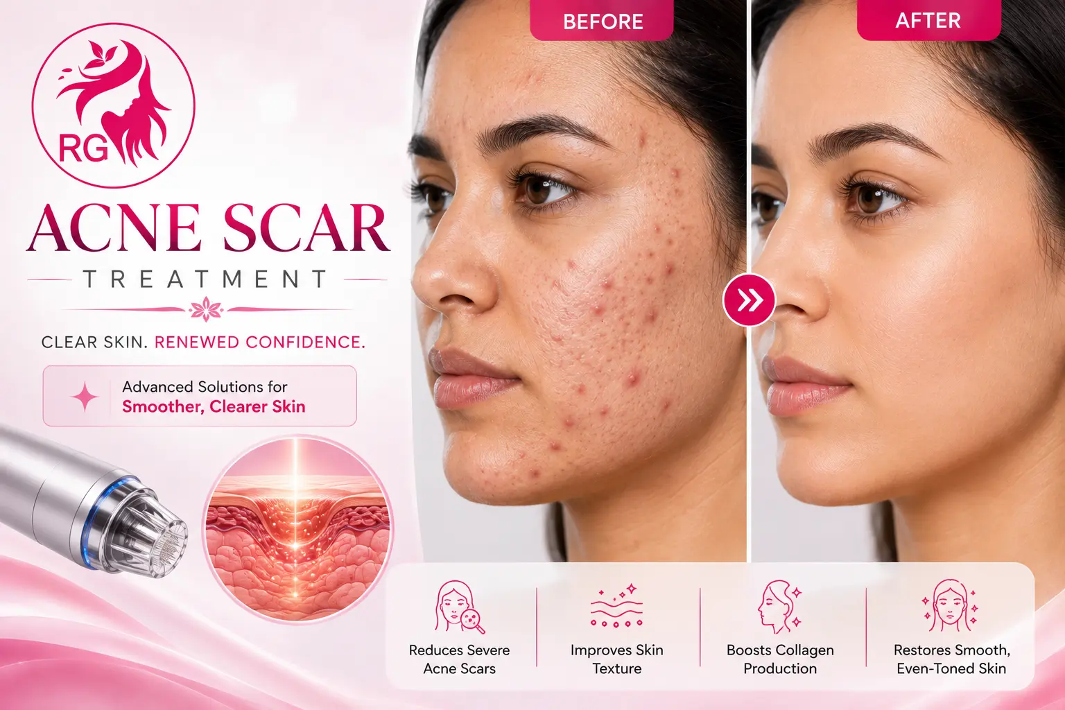 Best acne scar treatment near me