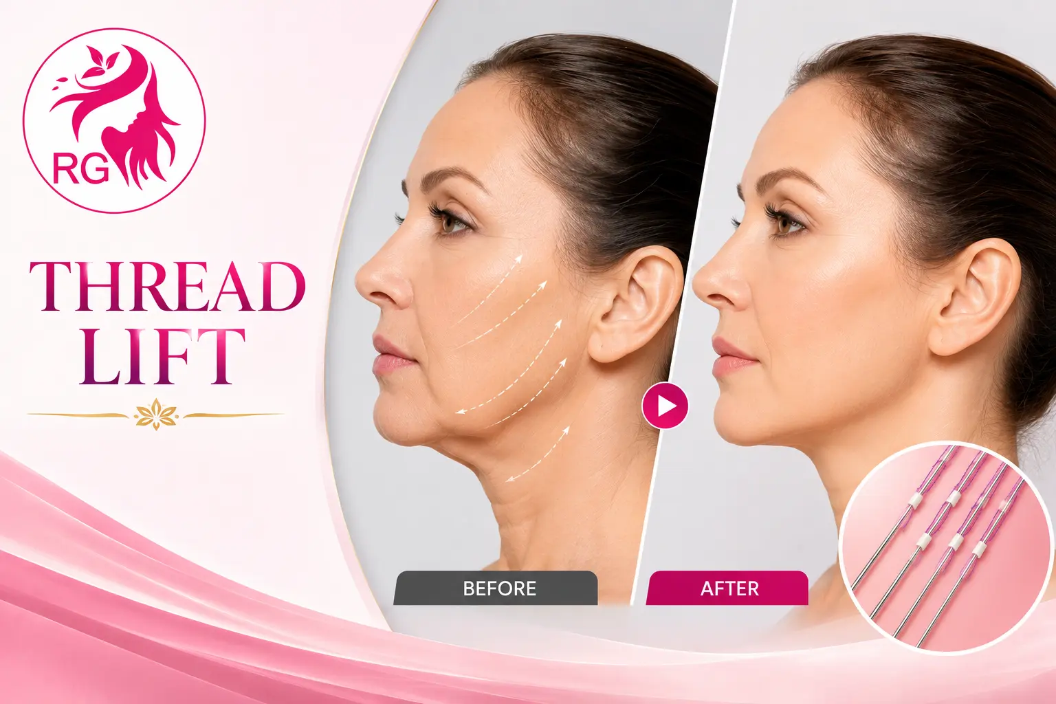 Best thread lift treatment in Lucknow