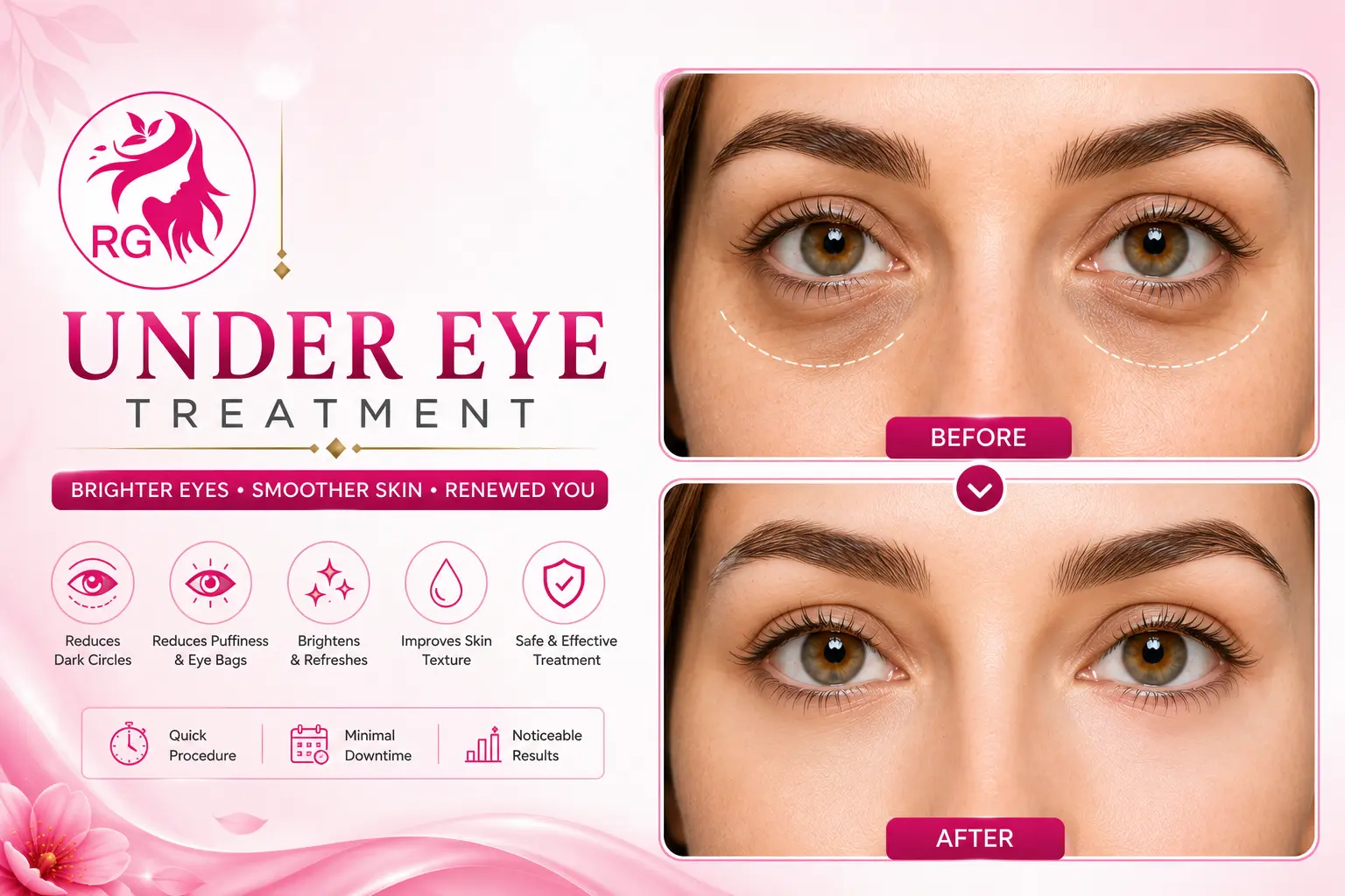 Under eye Dark circle treatment